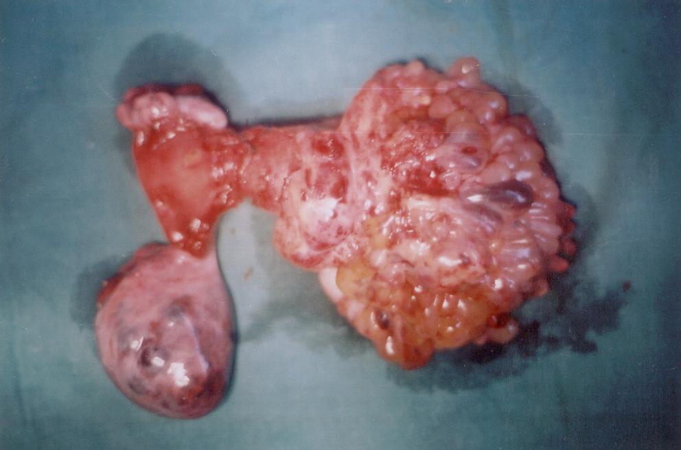 Ovariancyst Removed